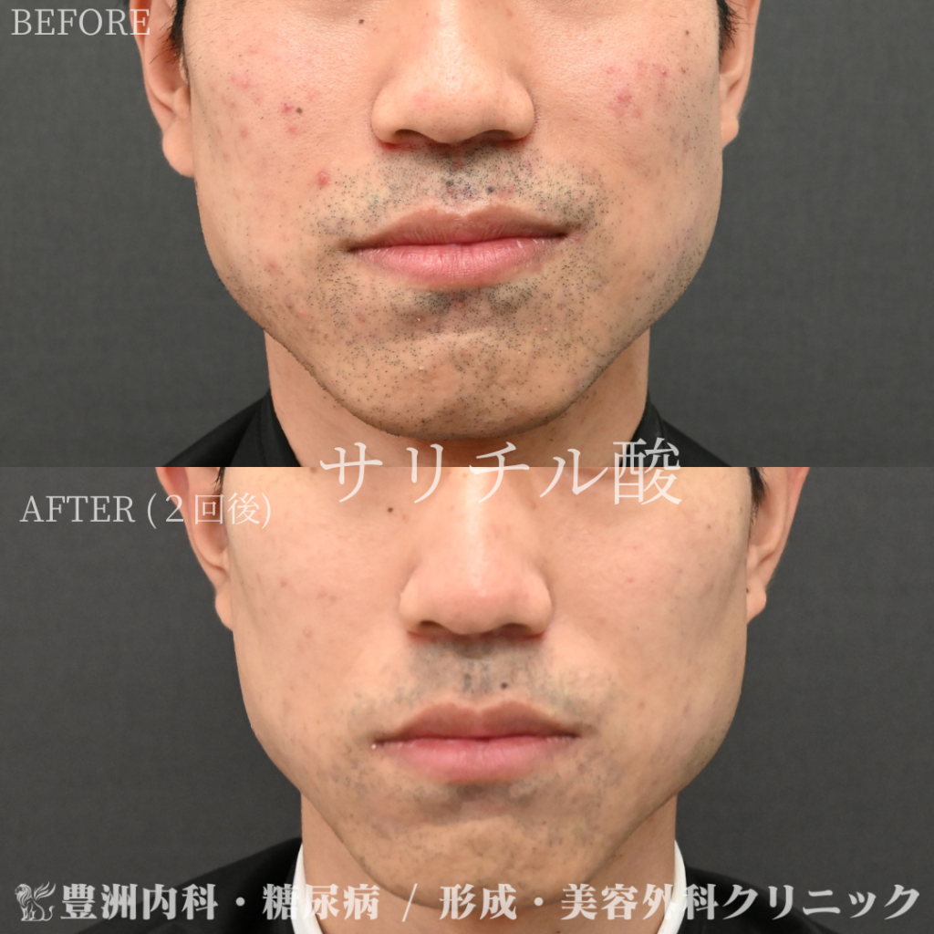 サリチル酸ピーリング  / 30代男性